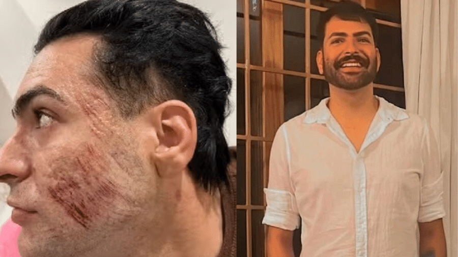 henrique chagas ficou com ferimentos no rosto apos peeling de fenol 1721234344727 v2 900x506