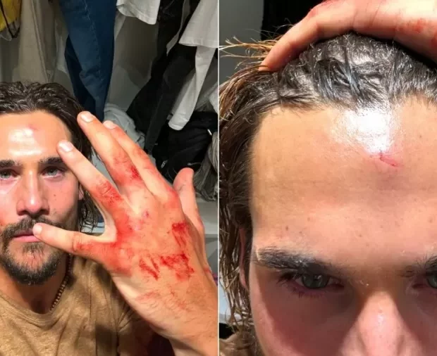 nicolas prattes mostra machucados apos gravacao de novela 1726929968044 v2 900x506.jpg