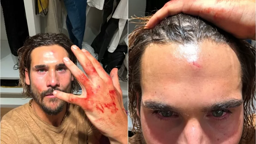 nicolas prattes mostra machucados apos gravacao de novela 1726929968044 v2 900x506.jpg