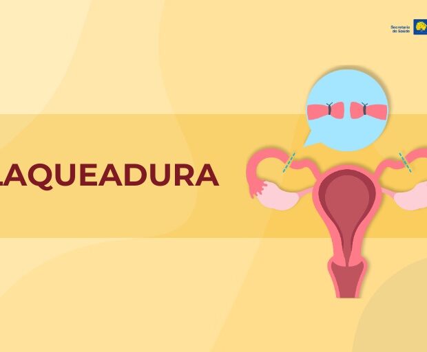 laqueadura