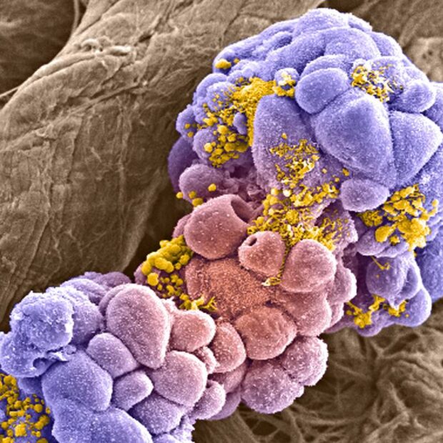 células de câncer de mama