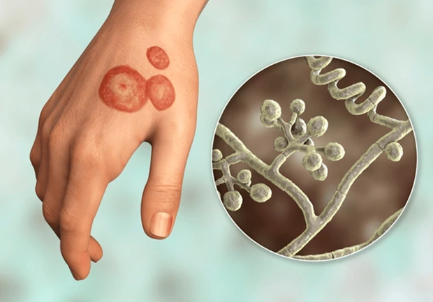 trichophyton indotineae