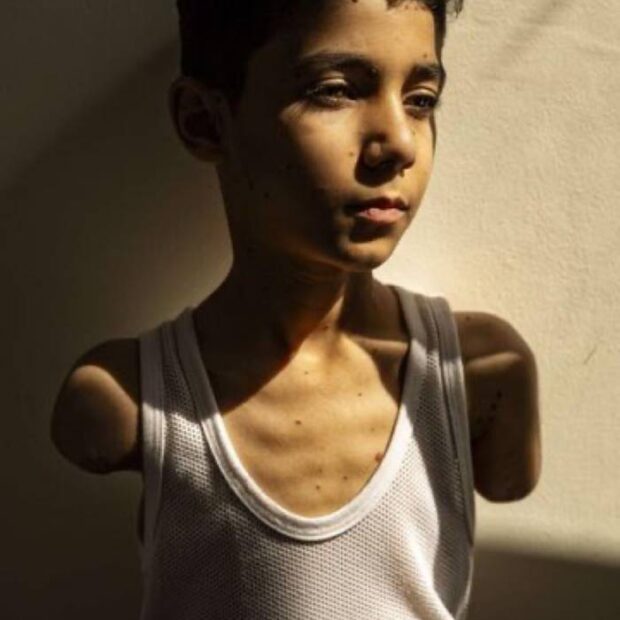 retrato de criança palestina que perdeu braços durante ataque de israel vence world press photo
