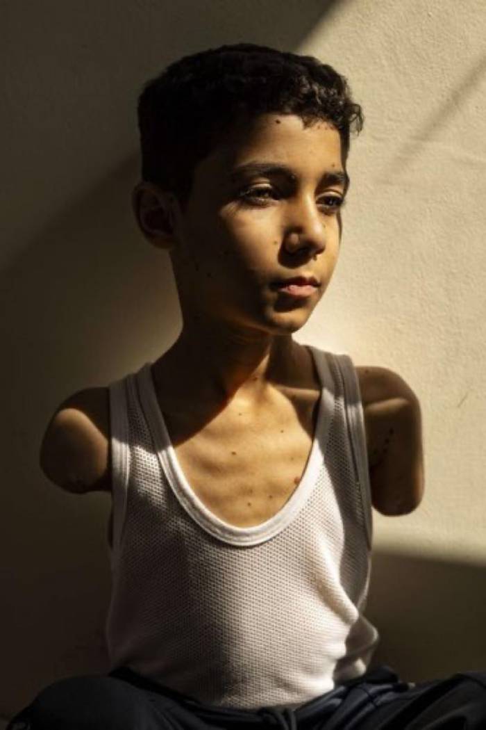 retrato de criança palestina que perdeu braços durante ataque de israel vence world press photo