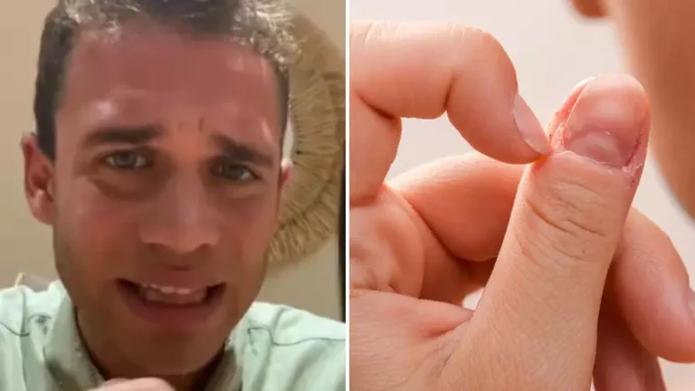 A batalha pela vida depois de um simples costume virar um pesadelo