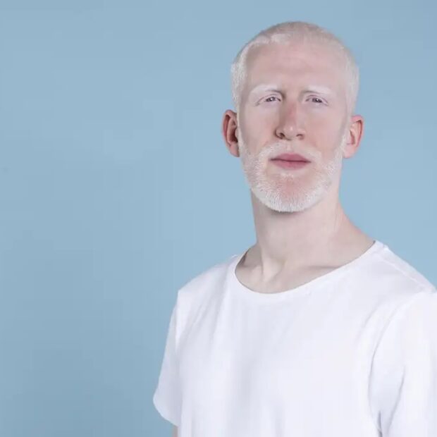 homem albino. foto freepick via agência brasil