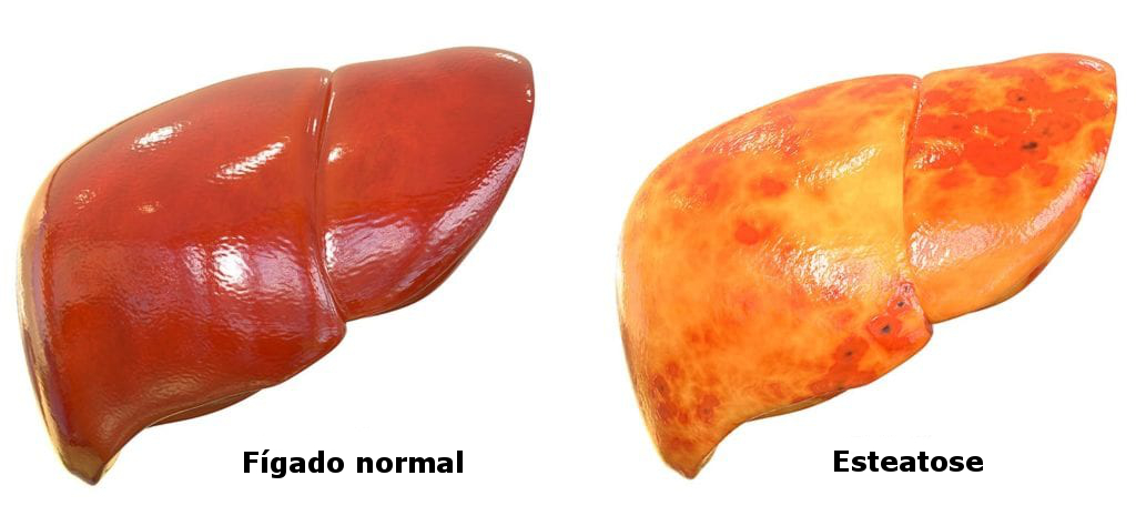 esteatose