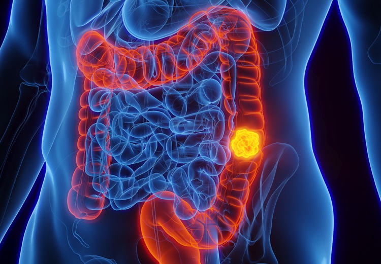 cancer colorretal reprodução sociedade brasileira de oncologia