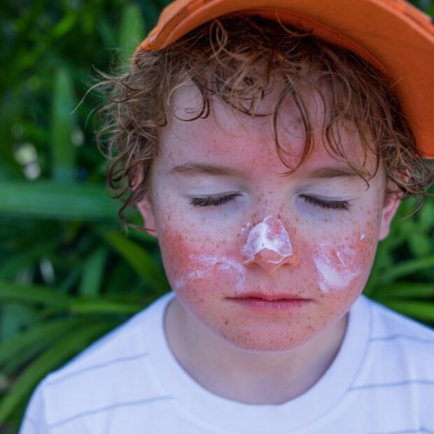 30.12. cuidados ao sol. foto divulgação igesdf5