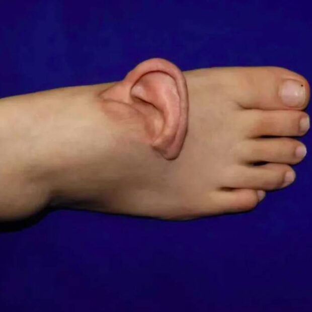 Médicos chineses enxertam orelha em pé de paciente