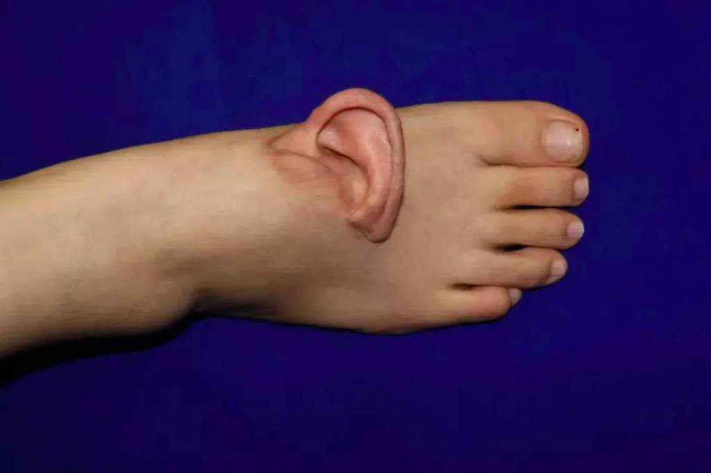 Médicos chineses enxertam orelha em pé de paciente