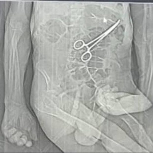 família acusa hospital de esquecer pinça em corpo de idoso morto