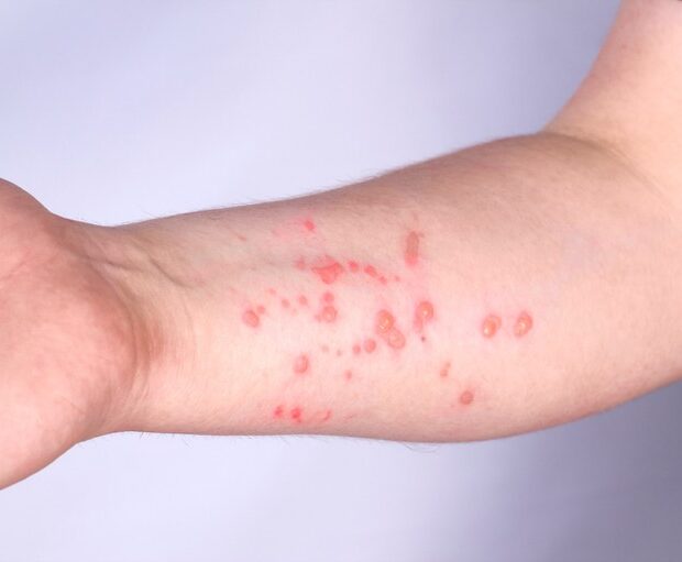 Foto: Mpox / Getty Images