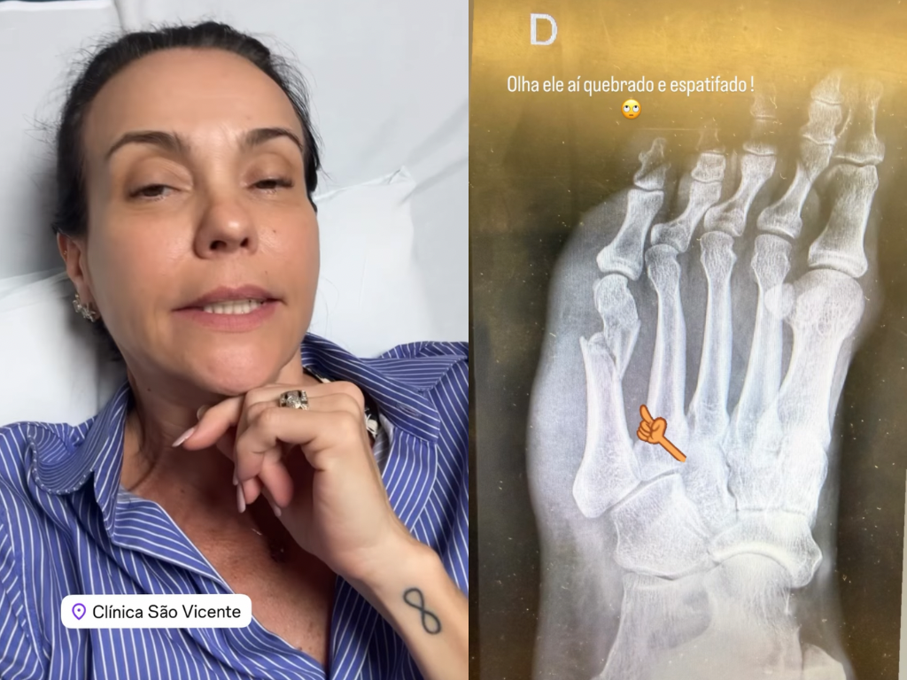 Flávia Monteiro quebra pé em acidente com cachorro e vai operar