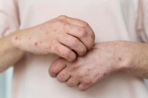 lupus
