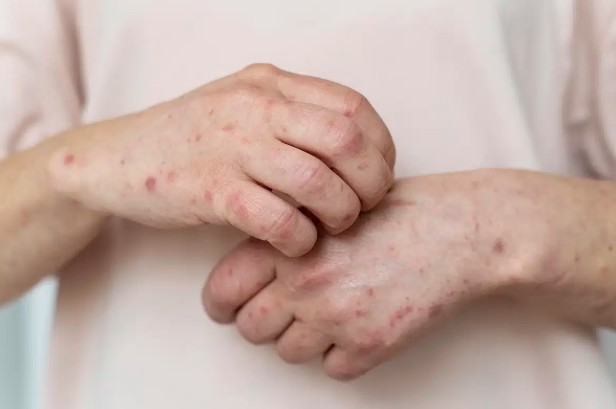 lupus