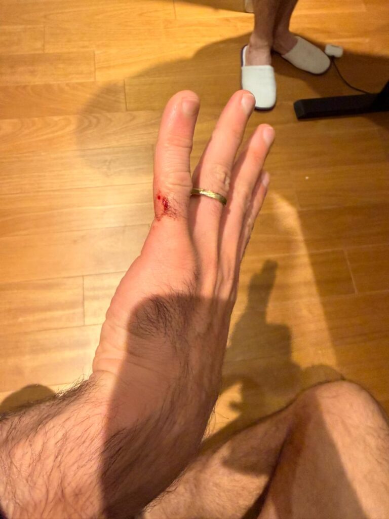 Depois do assalto, ficou o susto, os machucados e a certeza de que hoje ninguém mais mexe no celular tranquilamente nem com o vidro fechado.