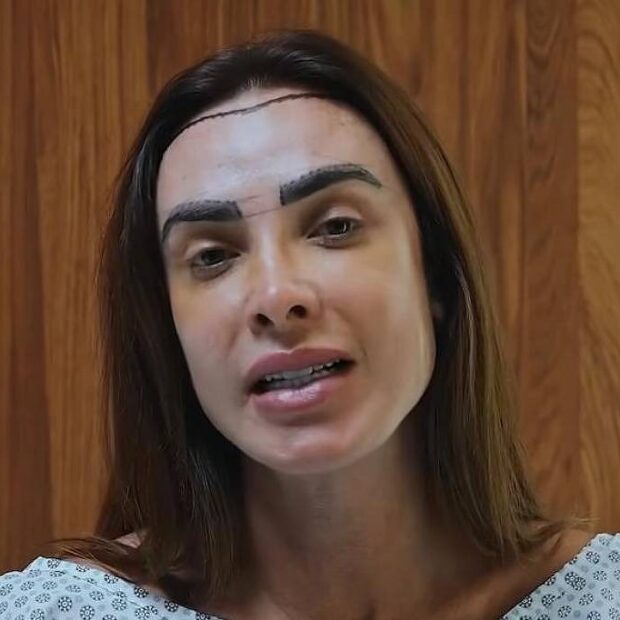 Nicole Bahls revelou que passou por um transplante capilar após enfrentar um quadro de alopecia androgenética.