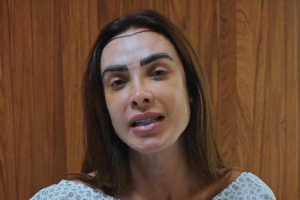 “Mais cabeluda”: Nicole Bahls faz transplante capilar sem raspar a cabeça