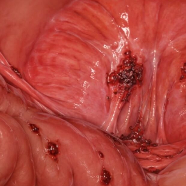 endometriose profunda na cavidade pélvica, acometendo o peritônio e órgãos próximos (representação anatômica)