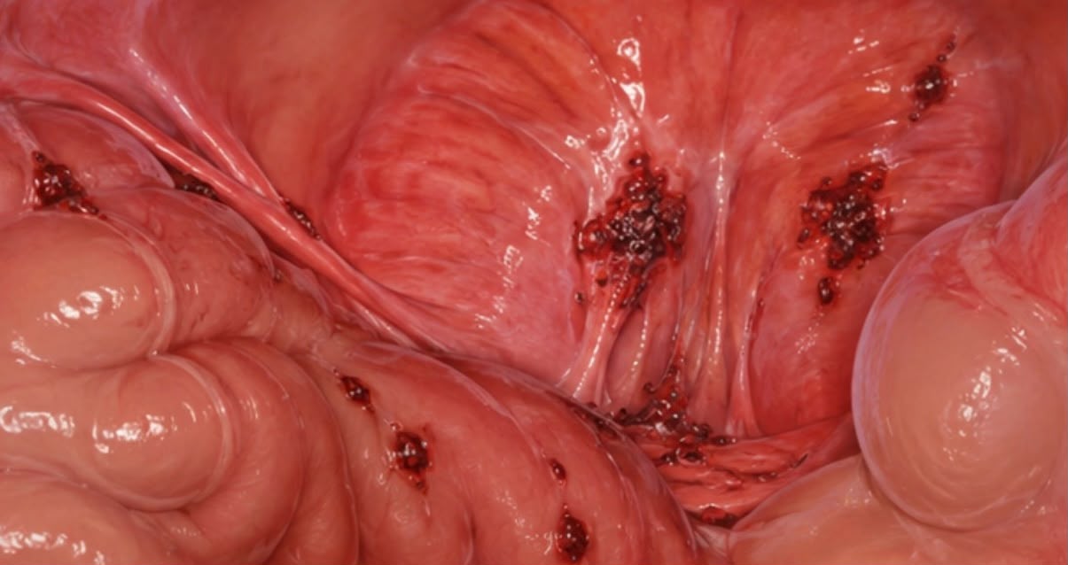 endometriose profunda na cavidade pélvica, acometendo o peritônio e órgãos próximos (representação anatômica)