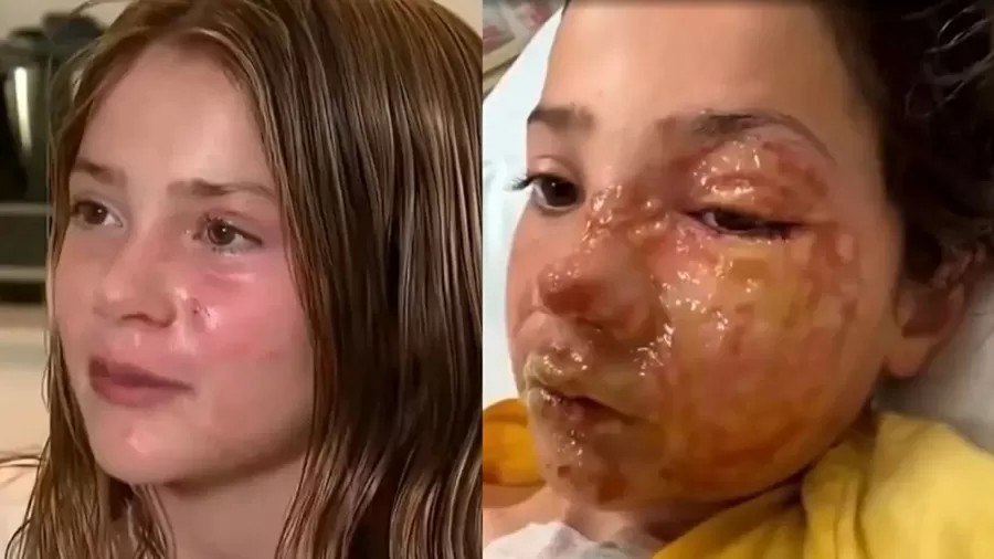 menina de 10 anos sofreu queimaduras graves apos aquecer um brinquedo sensorial no micro ondas e reproduzir uma tendencia viral vista nas redes sociais 1782312094028 v2 900x506.jpg