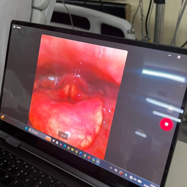 videondoscopia da deglutição avaliação instrumental faringolaringea da segurança e eficiência da deglutição com diferentes consistências. orl e fonoaudiólogo. (2)