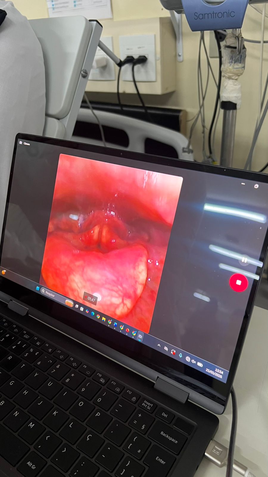 videondoscopia da deglutição avaliação instrumental faringolaringea da segurança e eficiência da deglutição com diferentes consistências. orl e fonoaudiólogo. (2)