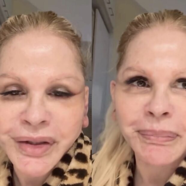 Monique Evans mostrou, sem filtros, como está a recuperação após o mini lifting facial e chamou atenção pela transparência com os seguidores. Créditos: Reprodução/Instagram