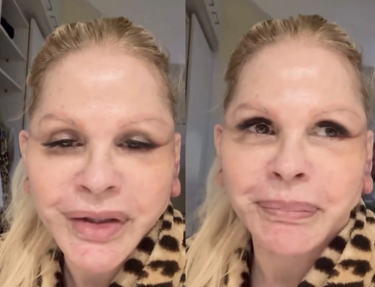 Monique Evans mostrou, sem filtros, como está a recuperação após o mini lifting facial e chamou atenção pela transparência com os seguidores. Créditos: Reprodução/Instagram