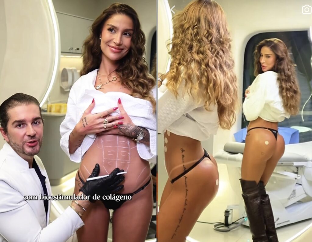 Bianca Andrade mostrou o resultado de procedimentos estéticos durante as férias e reacendeu o interesse por técnicas que valorizam firmeza e naturalidade.
