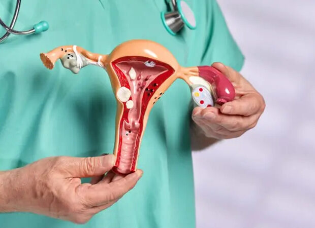endometriose