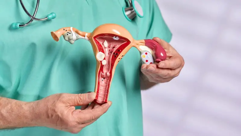 endometriose