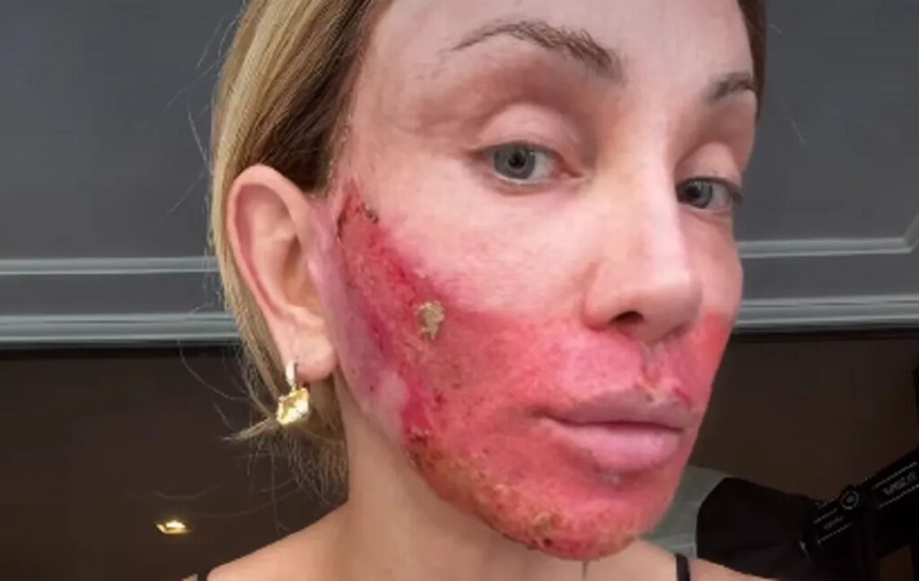  Apesar do aspecto intenso da pele, Maya garantiu aos seguidores que não sente dor
