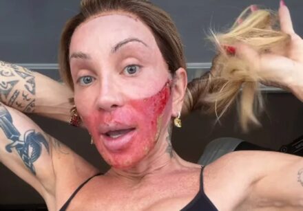 Maya Massafera mostrou o rosto bastante vermelho no terceiro dia de recuperação do procedimento Line Skin