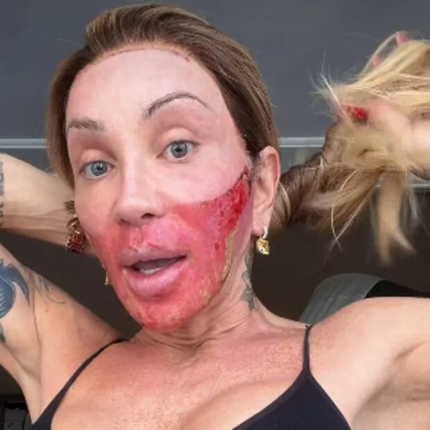 Maya Massafera mostrou o rosto bastante vermelho no terceiro dia de recuperação do procedimento Line Skin