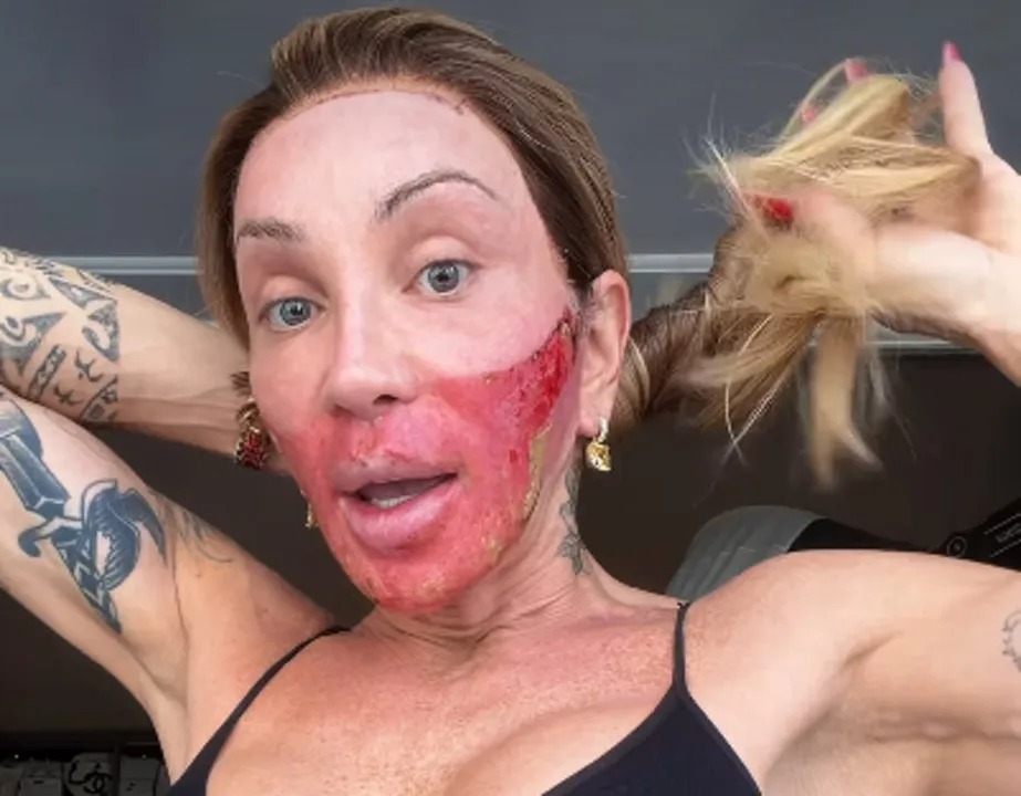 Maya Massafera mostrou o rosto bastante vermelho no terceiro dia de recuperação do procedimento Line Skin
