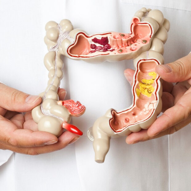 câncer de intestino