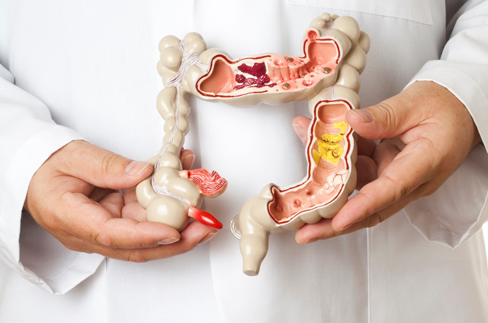 câncer de intestino