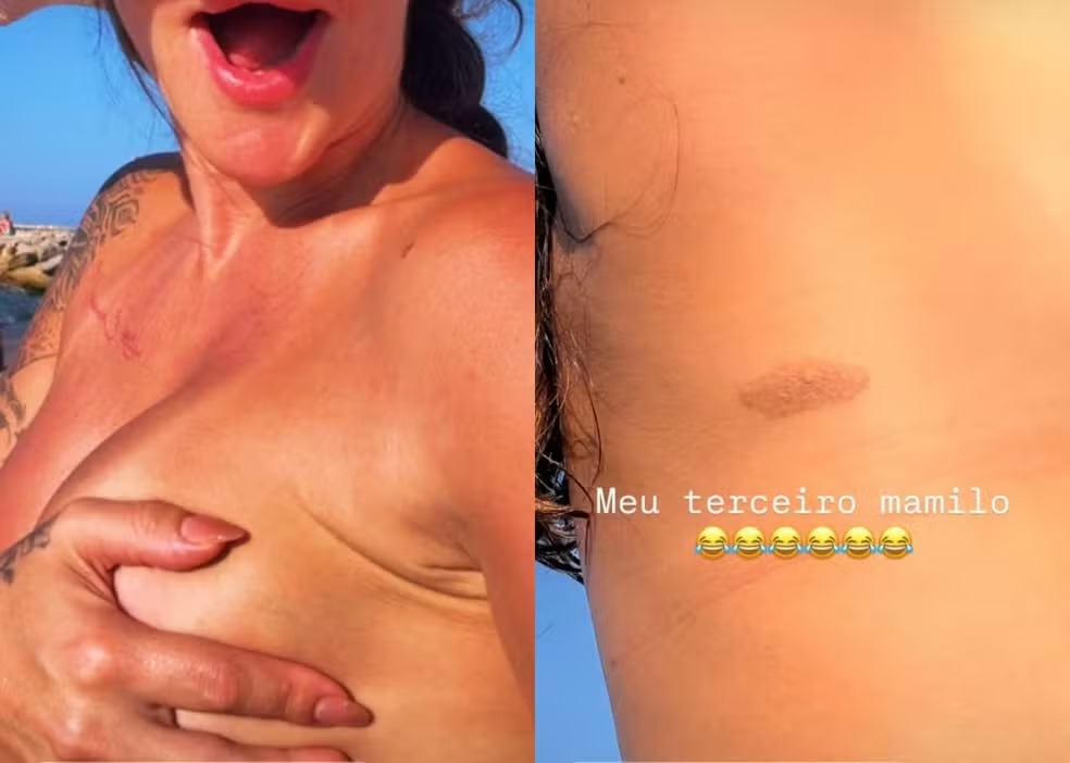 Laura brincou ao descobrir uma mancha que parecia um “terceiro mamilo”