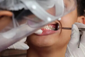 carie dentista