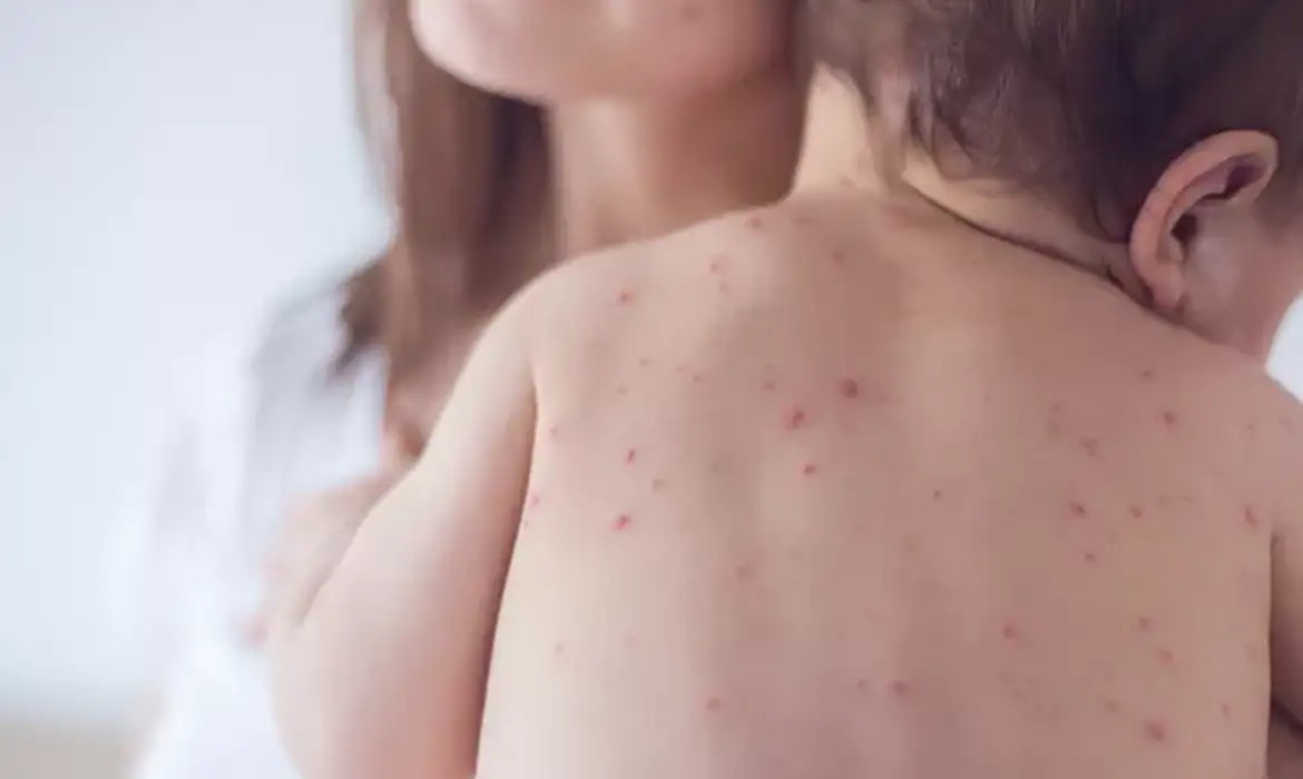 sarampo 1