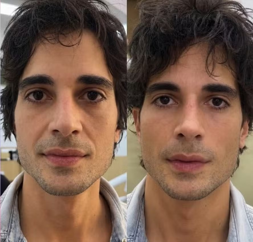 O cantor destacou mudanças no formato do nariz