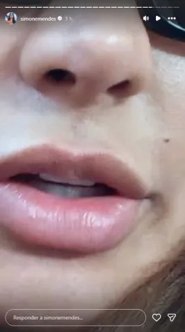 Cantora afirmou que não fez rinoplastia e que utilizou apenas um fio estético