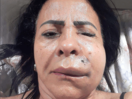 Dentista condenado por deformar rosto de paciente ainda deve R$ 97 mil à vítima no DF