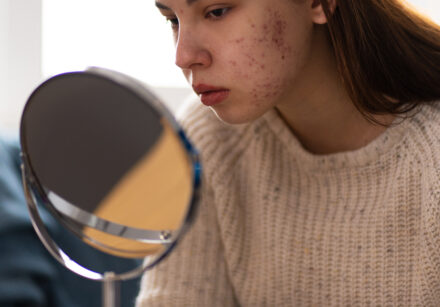 person dealing with rosacea