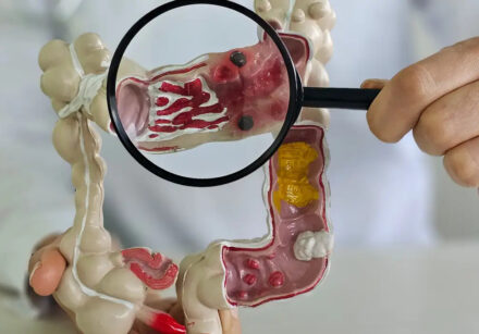 câncer de intestino