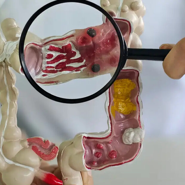 câncer de intestino